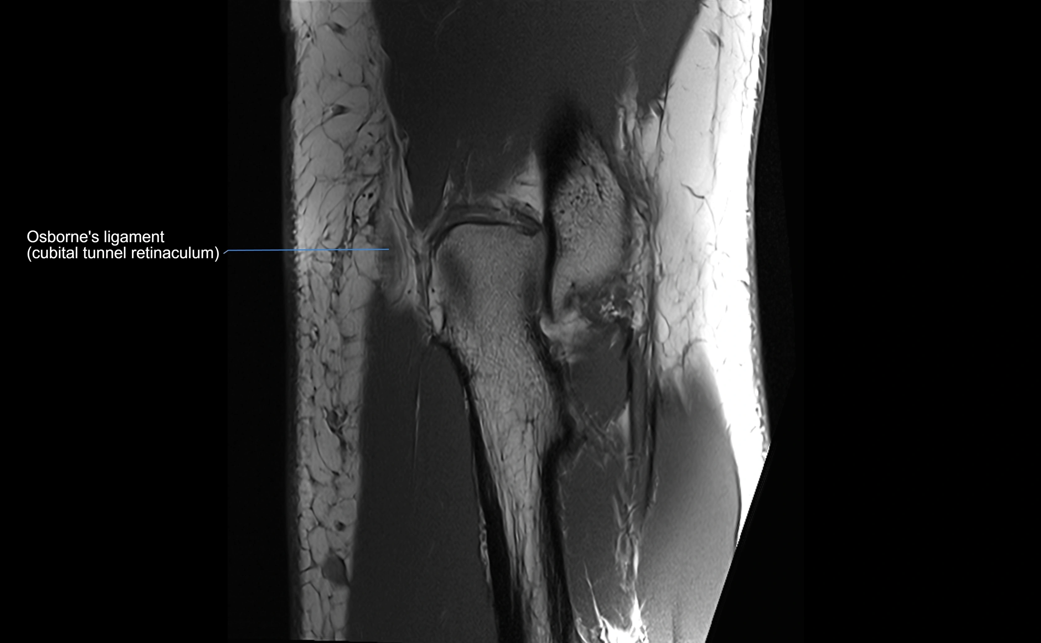 MRI elbow ligaments coronal cross sectional anatomy 3T  radiology  image-img-07001-00025.webp